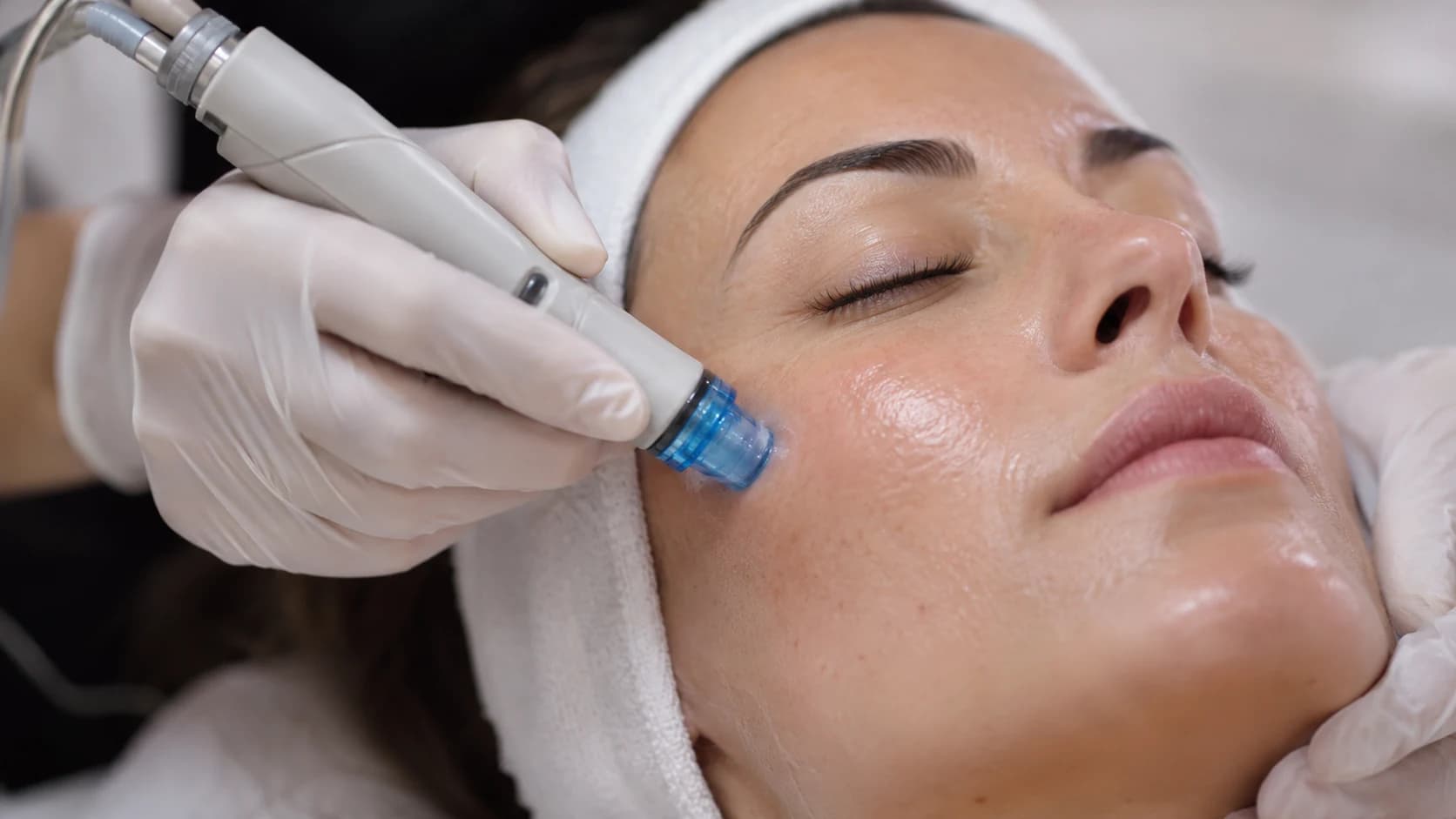 Hydrafacial op de wang: de behandelkop met blauwe tip, het gezicht en een gehandschoende hand